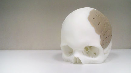 oxpekk-ig skull implant